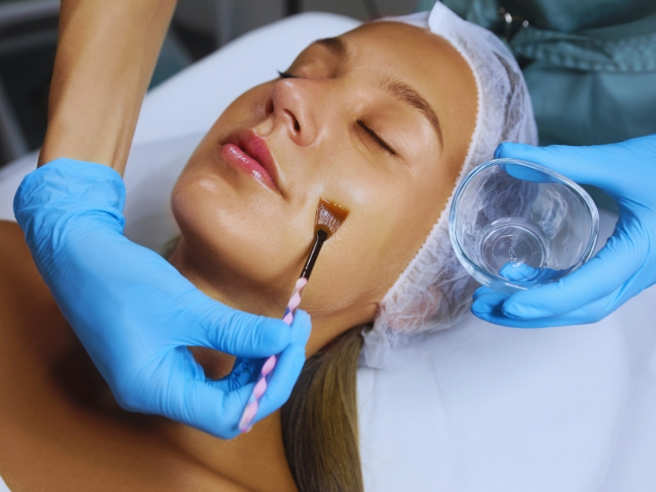 peeling quimico en verano